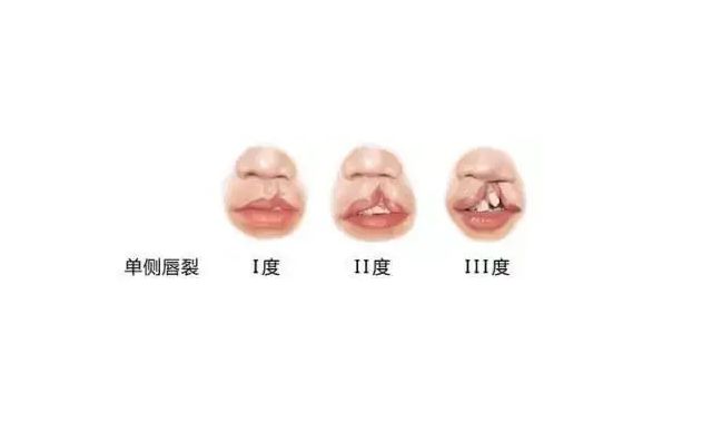 唇腭裂修复需要多少钱(孕期中后期B超能检测出唇裂吗)